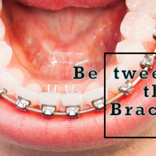 Between the Braces (featured image)