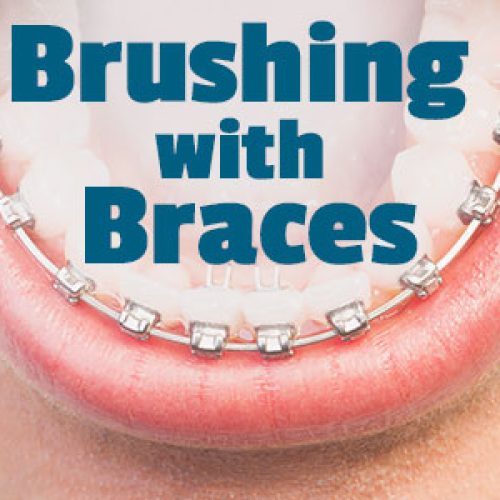 Brushing with Braces: Cleaning Every Nook & Cranny (featured image)