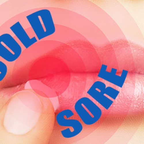 Do I Have Herpes? Cold Sores 101 (featured image)