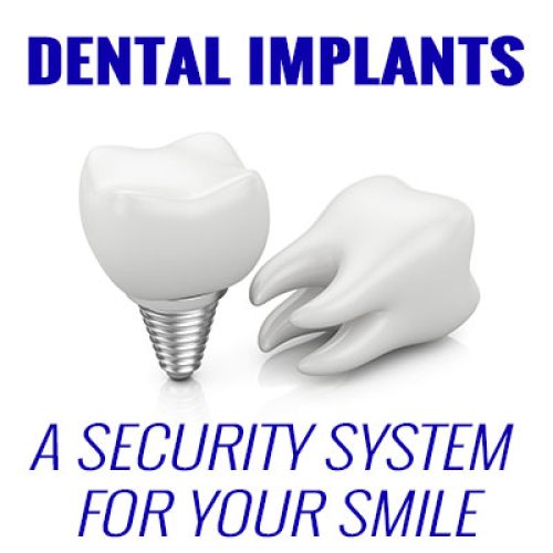 Dental Implants – A Security System for Your Smile (featured image)