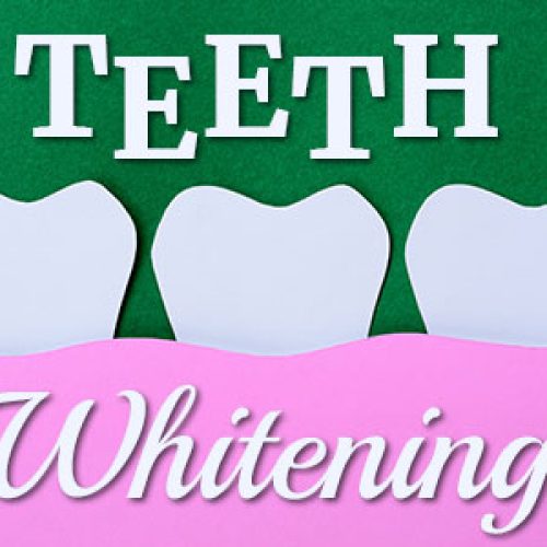 Types for All Stripes: Teeth Whitening (featured image)